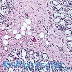 Gravesova nemoc (hypertyreóza tyreotoxikóza, grevsa nemoc): patologické anatomie
