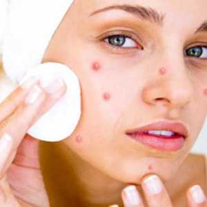 Dysbacteriosis a pupínky na obličeji