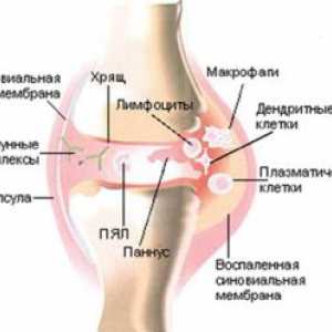 Dysenterický (posledizenteriyny) artritida