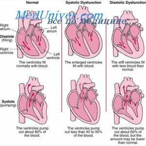 Srdeční výdej po infarktu. Kompenzovat srdeční selhání