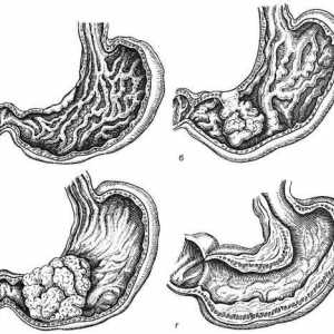 Formy rakoviny žaludku, raznovvidnosti syndromů, velikost, lokalizace