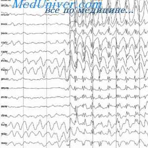 Co způsobuje a zastaví velký epileptický záchvat? Malaya epilepsie