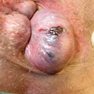 Hemoroidy a infekce, léčba infekčních nemocí