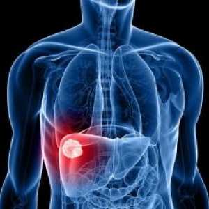Hepatocelulární karcinom jater: symptomy, léčba, prognózu, diagnózu