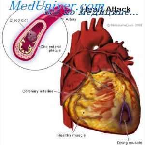 Infarkt myokardu. Příčin úmrtí v infarkt myokardu
