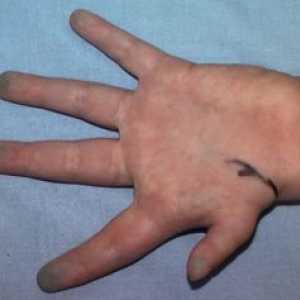 Hypoplazie prvních prstů