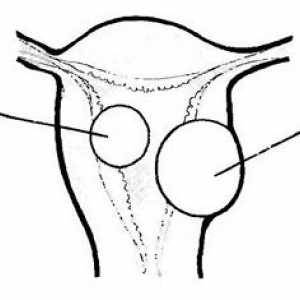 Hysteroskopie v diagnostice a léčbě děložních fibroidů