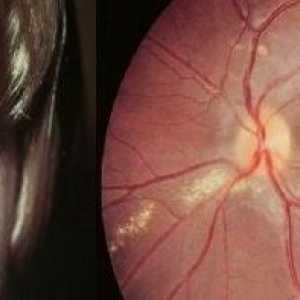 Oční larvální toxokaróza, příznaky a léčba u dospělých