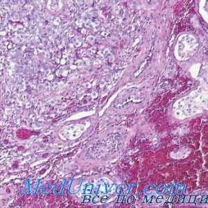 Gormonalnoaktivnye testikulární nádory leydigomy