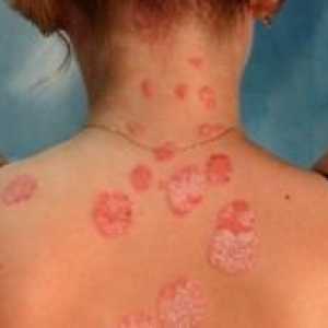 Chronické účinky na kůži na sluneční záření