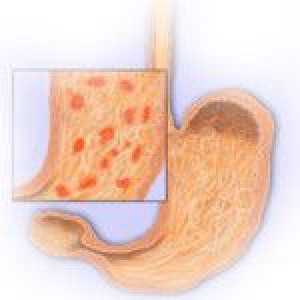Chronická erozivní gastritidu, její příznaky a stravy pomoc při léčbě