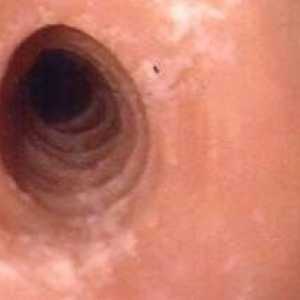 Infekce (herpetická) ezofagitida