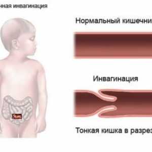 Intususcepce u dětí: příčiny, příznaky, léčba, symptomy