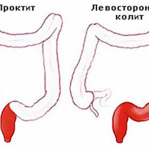 Ulcerózní kolitida je forma distální