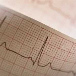 Electric infarkt nestabilita: Prostředky pro léčbu, příčiny, příznaky, znaky