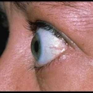 Endokrinní oftalmopatie: léčba, příznaky, diagnostika, klasifikace