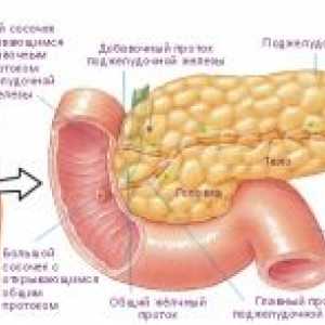 Endokrinní nádor slinivky břišní