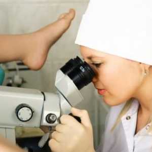 Cervikální endometriózy, léčba, příznaky, znaky, příčiny, fáze