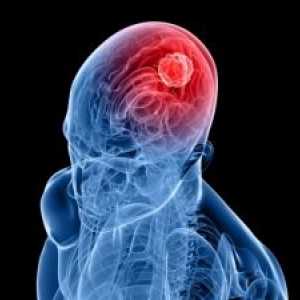 Epidurální hematom mozku: jsou symptomy, léčba, důsledky