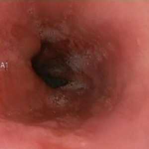 Erozivní jícnový reflux a gastritida