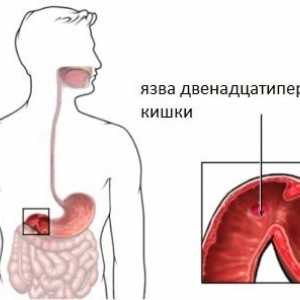 Jak dělá duodenální vřed, příznaky žaludečního vředu?
