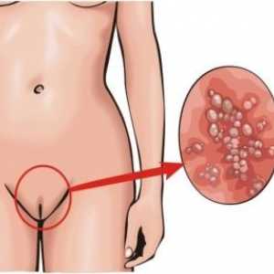 Candida vaginitida: léčba, příznaky, příčiny, příznaky