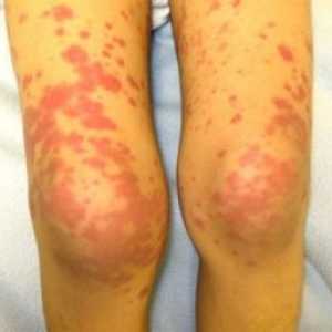 Kožní vaskulitida: Léčba, Symptomy