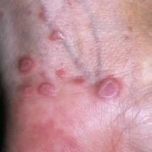 Lichen planus: příčiny, příznaky, léčba, symptomy