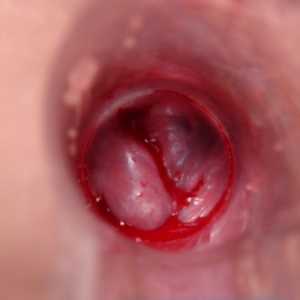 Krvácení z hemoroidů: příčiny a léčba komplikací