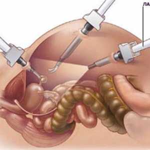 Laparoskopie slinivky v pankreatitidy