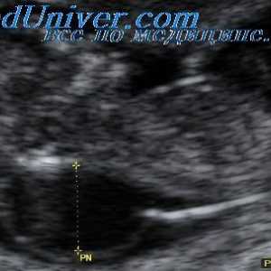 Metody vyhodnocování ultrazvuk PROSÁKNUTÍ. Reprodukovatelnost měření nuchale