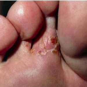 Mykóza nohou: léčba, příznaky, prevence, příčiny