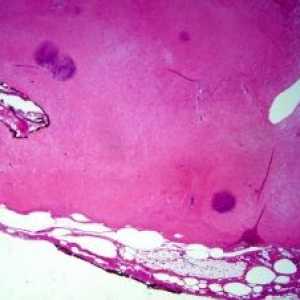 Mikroskopická kolitida: léčba, příznaky, příčiny, příznaky