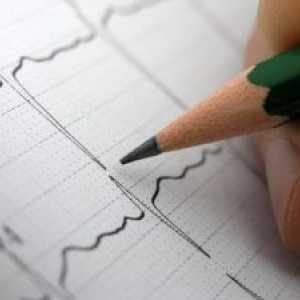 Srdeční arytmie, léčba, příčiny, příznaky, znaky