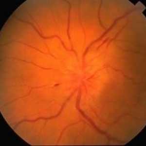 Optická neuritida: symptomy, léčba, příčiny, diagnostiku, prognostiku