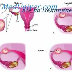 Zkouška děloha. Vyšetření pánevní dutiny s mimoděložním těhotenstvím