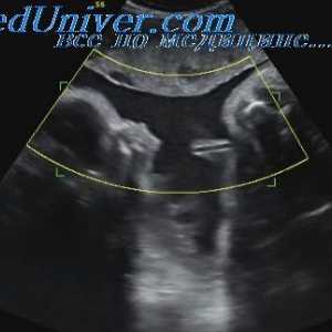 Diskutujte bezpečnost ultrazvukového použití. Účinek ultrazvuku na tkáň