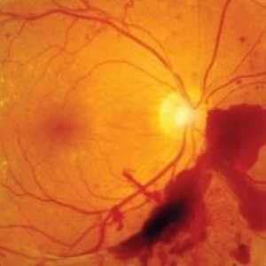 Okluze centrální retinální arterie: léčba, příčiny, diagnóza