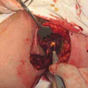 Chirurgický zákrok k odstranění hemoroidů a análních fisur