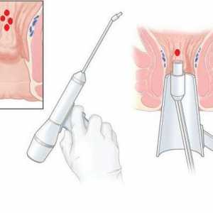 Chirurgické odstranění hemoroidy laserové současné léčby hemoroidů
