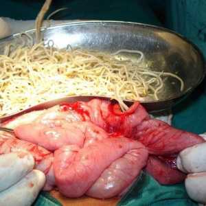 Chirurgický zákrok k odstranění červů, jak odstranit hlístů?