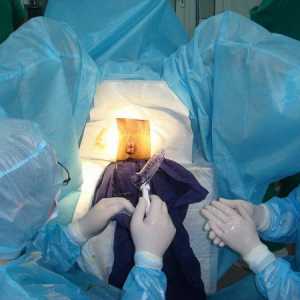 Chirurgické odstranění vnějších (vnější) hemoroidy