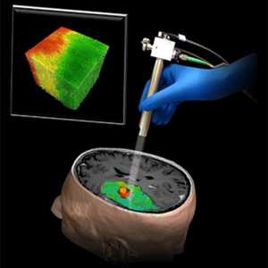 Optická sonda pro odstranění nádoru na mozku