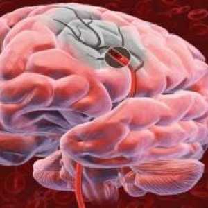 Nádor na mozku a její membrány, což vede k porážce zrakové dráhy