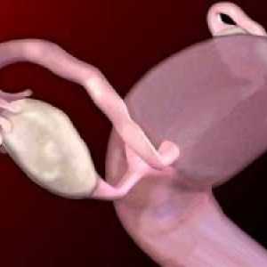 Nádorů vaječníků u žen benigních a maligních: symptomy, léčba, symptomy, příčiny