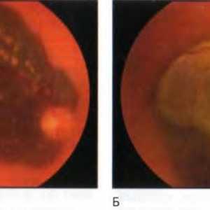Nádory sítnice a cévnatky: choroidální melanom
