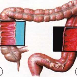 Komplikace ulcerózní kolitidy