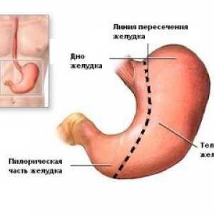 Komplikace resekci žaludku a gastrektomií