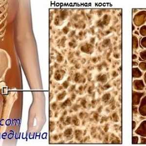 Osteomalacie. Osteoporóza a charakterizace osteoporózy