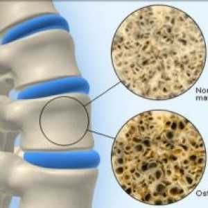 Osteoporóza Bone: léčba, příznaky, příčiny, příznaky, prevence, diagnóza